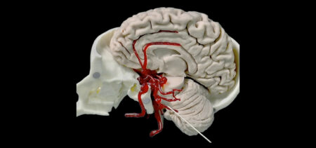 Arterie con Aneurisma