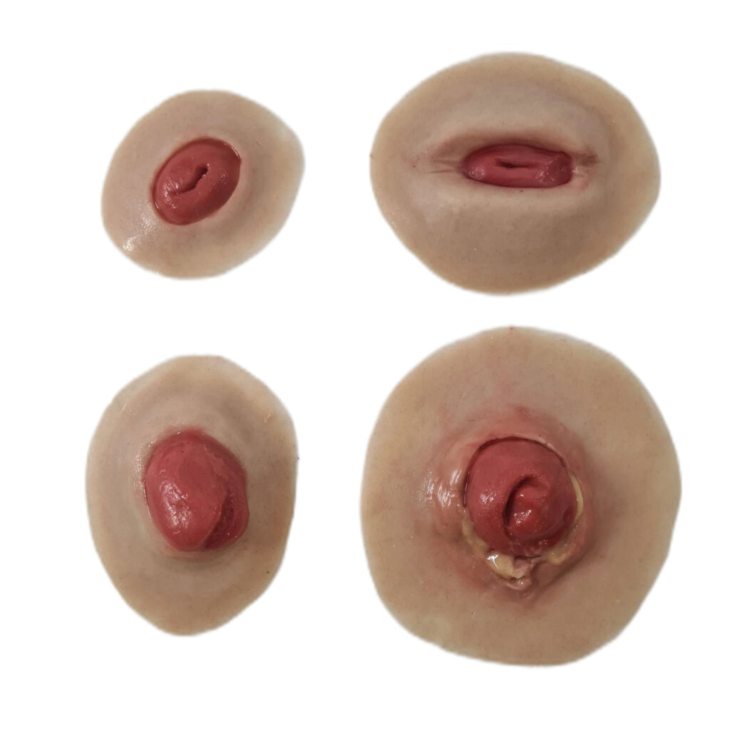 MP022 Set Ferite Colostomia