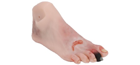 Piede Diabetico