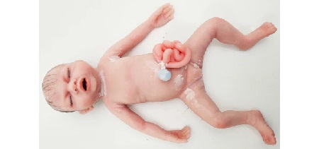 Baby Libby - Gastroschisi
